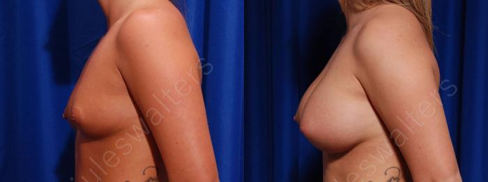 Before & After Breast Augmentation Case 97 View #3 View in Metairie and New Orleans, LA