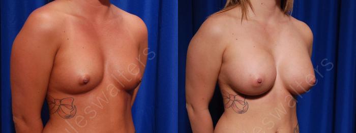 Before & After Breast Augmentation Case 97 View #4 View in Metairie and New Orleans, LA