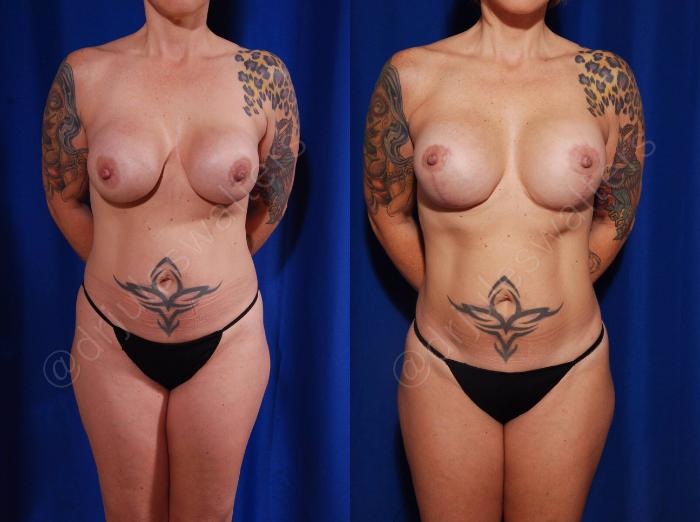 Before & After Breast Augmentation + Lift Case 102 View #1 View in Metairie and New Orleans, LA