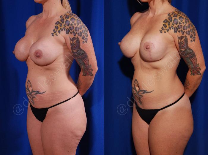 Before & After Breast Revision Case 102 View #2 View in Metairie and New Orleans, LA