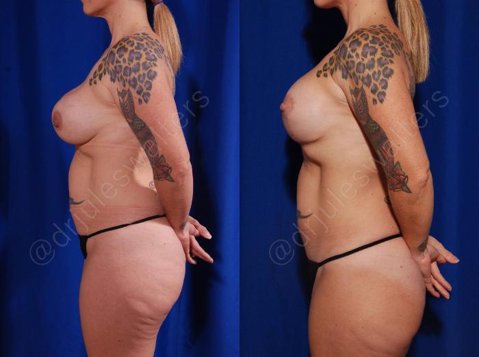 Before & After Breast Lift Case 102 View #3 View in Metairie and New Orleans, LA