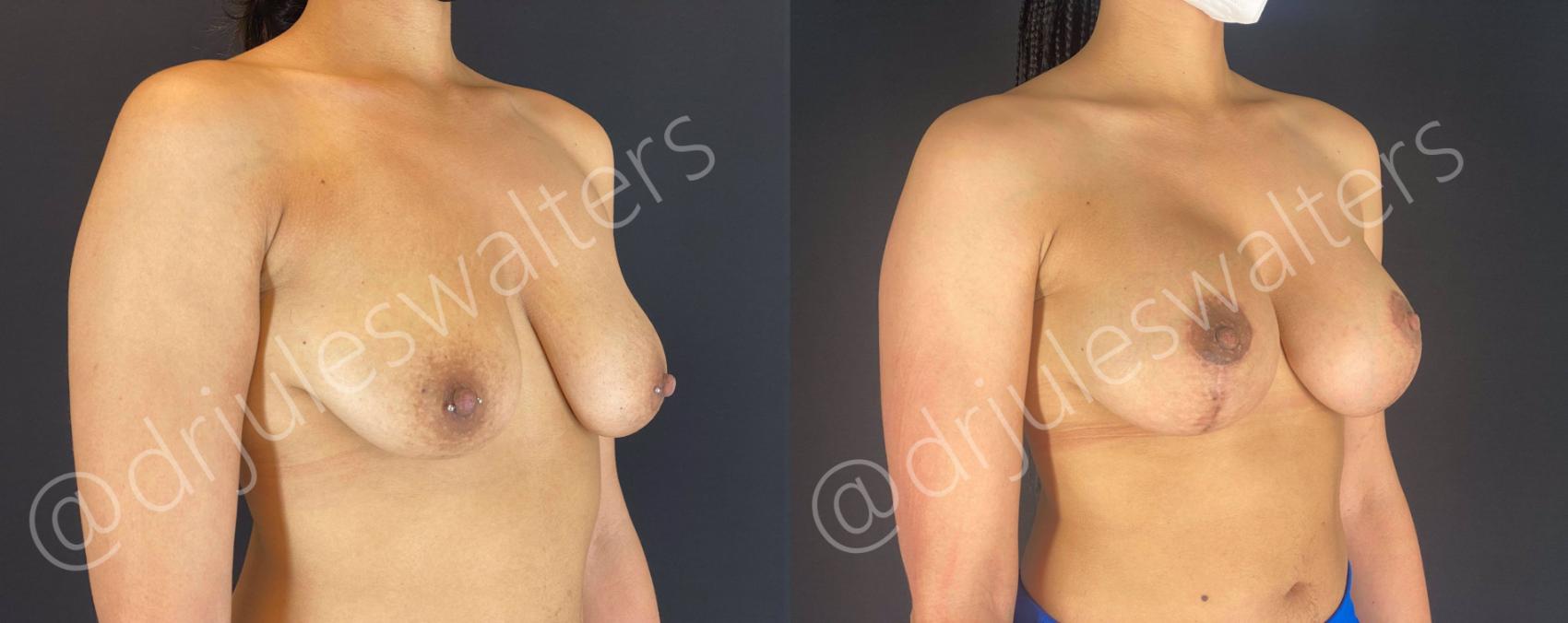 Before & After Breast Augmentation + Lift Case 107 View #1 View in Metairie, New Orleans, Covington, LA