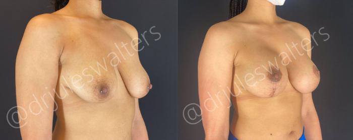 Before & After Breast Augmentation + Lift Case 107 View #1 View in Metairie and New Orleans, LA