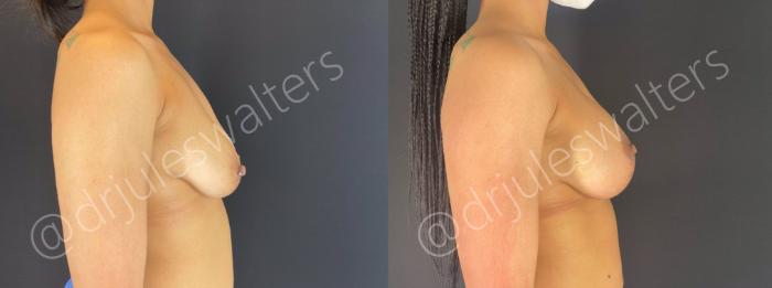 Before & After Breast Augmentation + Lift Case 107 View #2 View in Metairie and New Orleans, LA
