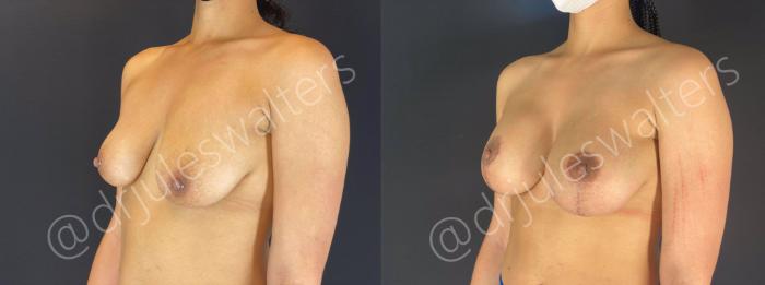 Before & After Breast Augmentation + Lift Case 107 View #3 View in Metairie and New Orleans, LA