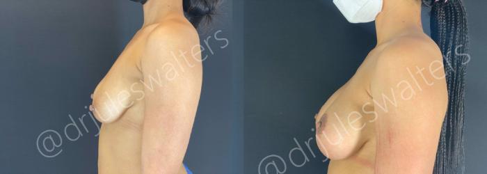 Before & After Breast Augmentation + Lift Case 107 View #4 View in Metairie and New Orleans, LA