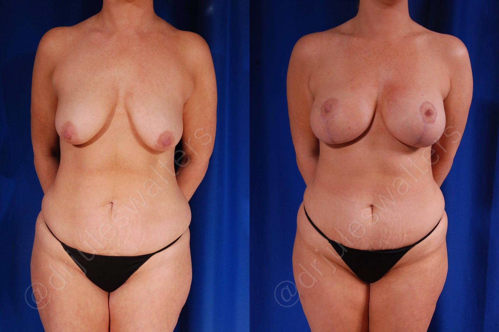 Before & After Breast Augmentation + Lift Case 108 View #1 View in Metairie, New Orleans, Covington, LA