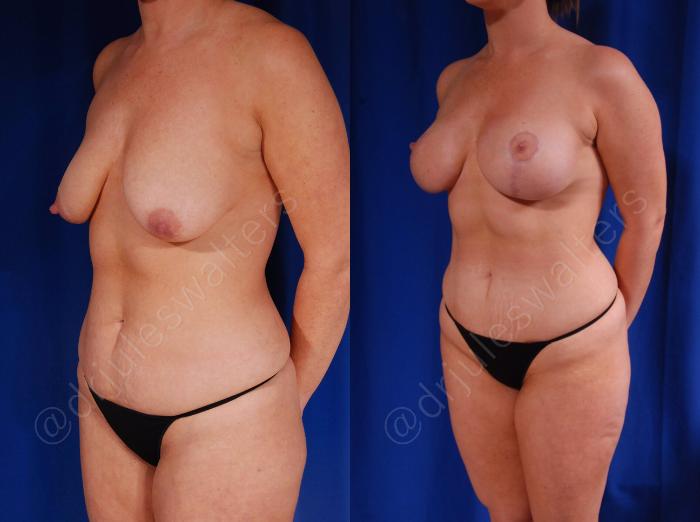 Before & After Breast Augmentation + Lift Case 108 View #2 View in Metairie and New Orleans, LA