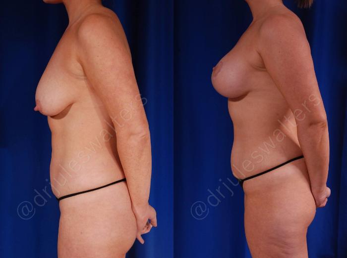 Before & After Breast Augmentation + Lift Case 108 View #3 View in Metairie and New Orleans, LA