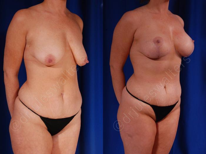 Before & After Breast Augmentation + Lift Case 108 View #4 View in Metairie and New Orleans, LA