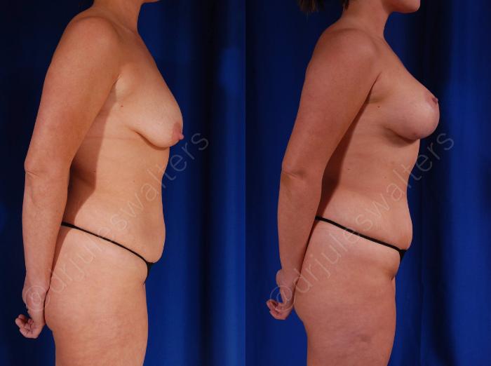 Before & After Breast Augmentation + Lift Case 108 View #5 View in Metairie and New Orleans, LA