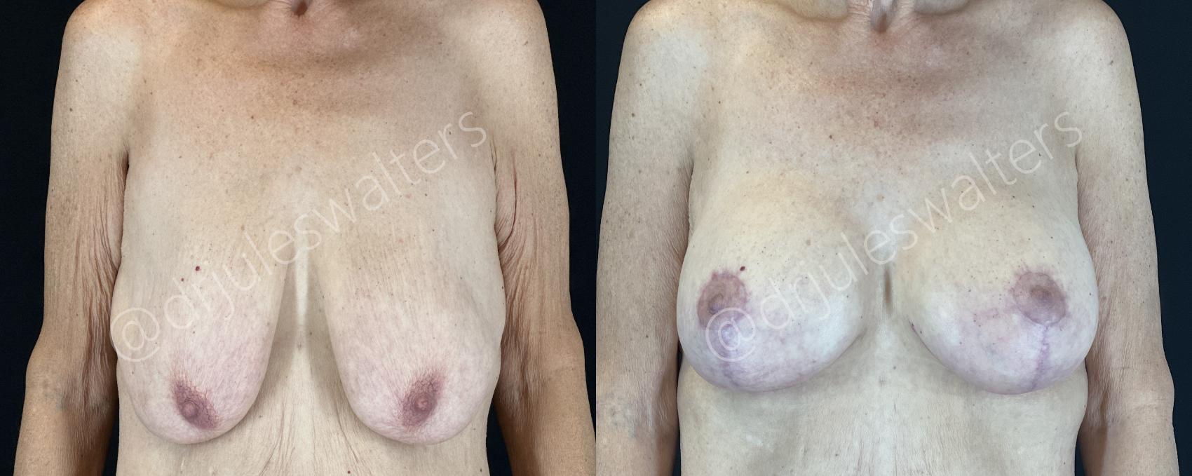 Before & After Breast Augmentation + Lift Case 143 Front View in Metairie and New Orleans, LA