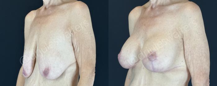 Before & After Breast Augmentation + Lift Case 143 Left Oblique View in Metairie and New Orleans, LA