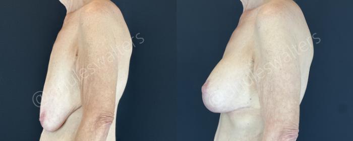 Before & After Breast Augmentation + Lift Case 143 Left Side View in Metairie and New Orleans, LA
