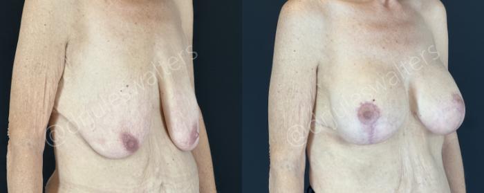 Before & After Breast Augmentation + Lift Case 143 Right Oblique View in Metairie and New Orleans, LA