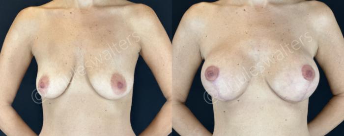 Before & After Breast Augmentation + Lift Case 145 Front View in Metairie and New Orleans, LA