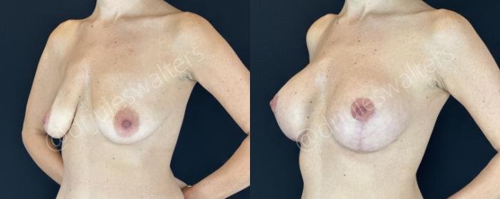 Before & After Breast Augmentation + Lift Case 145 Left Oblique View in Metairie and New Orleans, LA