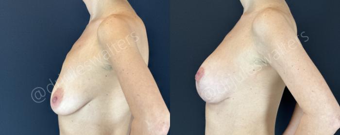 Before & After Breast Augmentation + Lift Case 145 Left Side View in Metairie and New Orleans, LA