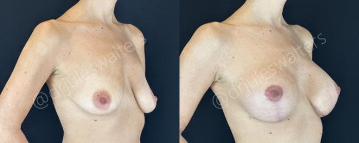 Before & After Breast Augmentation + Lift Case 145 Right Oblique View in Metairie and New Orleans, LA