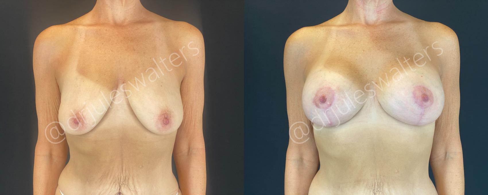 Before & After Breast Augmentation + Lift Case 146 Front View in Metairie and New Orleans, LA