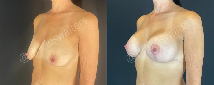 Before & After Breast Augmentation + Lift Case 146 Left Oblique View in Metairie and New Orleans, LA