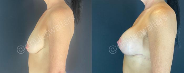 Before & After Breast Augmentation + Lift Case 146 Left Side View in Metairie and New Orleans, LA