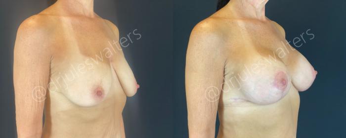 Before & After Breast Augmentation + Lift Case 146 Right Oblique View in Metairie and New Orleans, LA