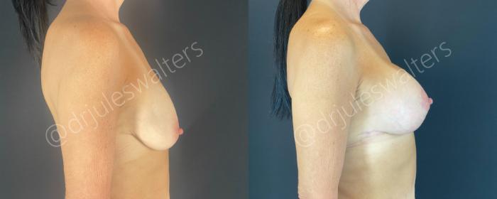 Before & After Breast Augmentation + Lift Case 146 Right Side View in Metairie and New Orleans, LA