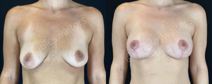 Before & After Breast Augmentation + Lift Case 147 Front View in Metairie and New Orleans, LA