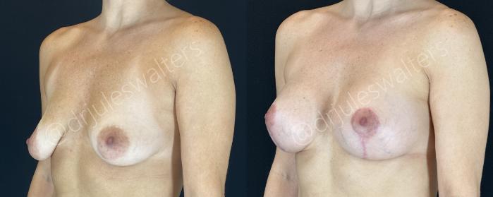 Before & After Breast Augmentation + Lift Case 147 Left Oblique View in Metairie and New Orleans, LA