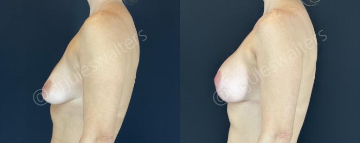 Before & After Breast Augmentation + Lift Case 147 Left Side View in Metairie and New Orleans, LA