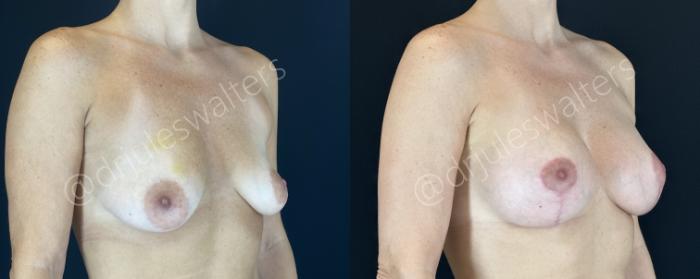 Before & After Breast Augmentation + Lift Case 147 Right Oblique View in Metairie and New Orleans, LA