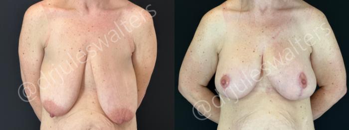 Before & After Breast Augmentation + Lift Case 179 Front View in Metairie and New Orleans, LA