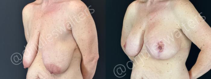 Before & After Breast Augmentation + Lift Case 179 Left Oblique View in Metairie and New Orleans, LA