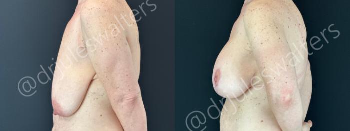 Before & After Breast Augmentation + Lift Case 179 Left Side View in Metairie and New Orleans, LA