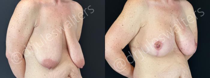 Before & After Breast Augmentation + Lift Case 179 Right Oblique View in Metairie and New Orleans, LA