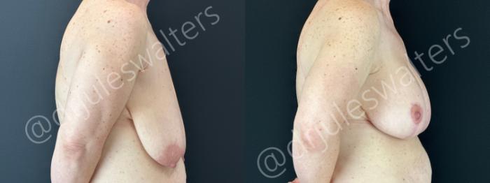 Before & After Breast Augmentation + Lift Case 179 Right Side View in Metairie and New Orleans, LA