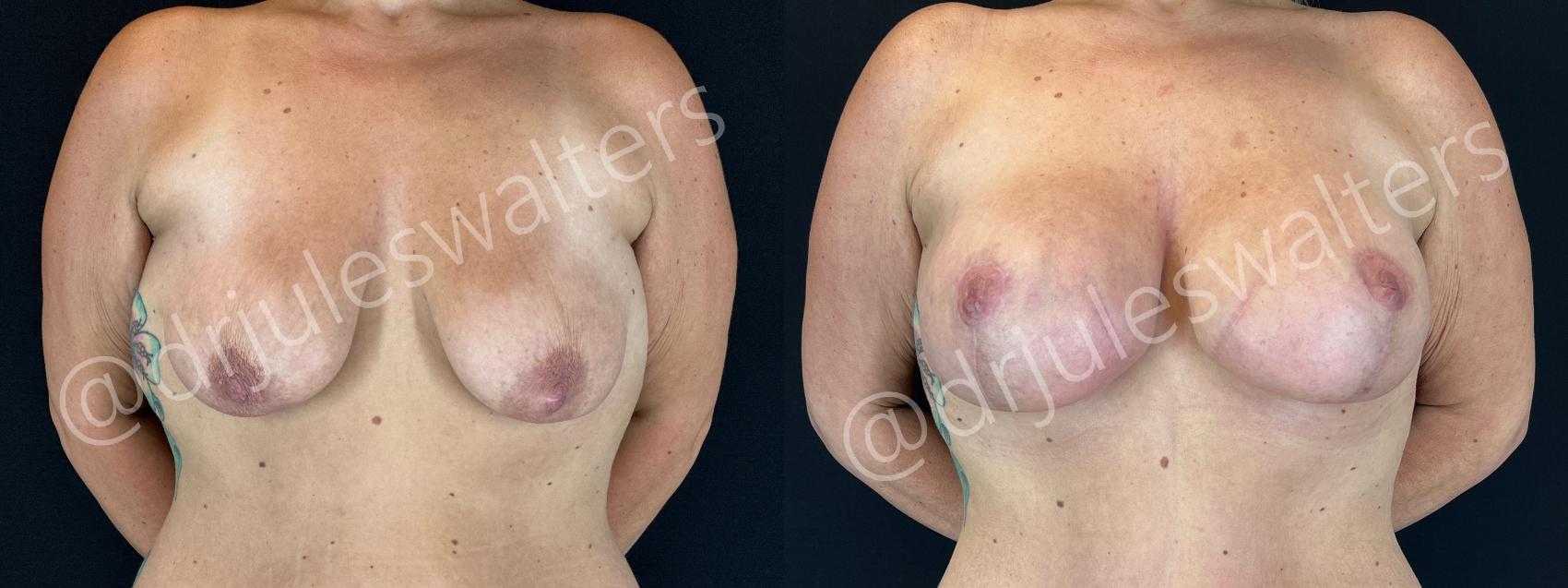 Before & After Breast Augmentation + Lift Case 191 Front View in Metairie and New Orleans, LA