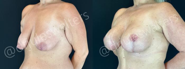 Before & After Breast Augmentation + Lift Case 191 Left Oblique View in Metairie and New Orleans, LA