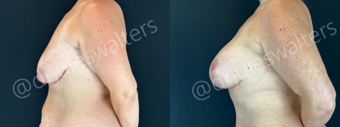 Before & After Breast Augmentation + Lift Case 191 Left Side View in Metairie and New Orleans, LA