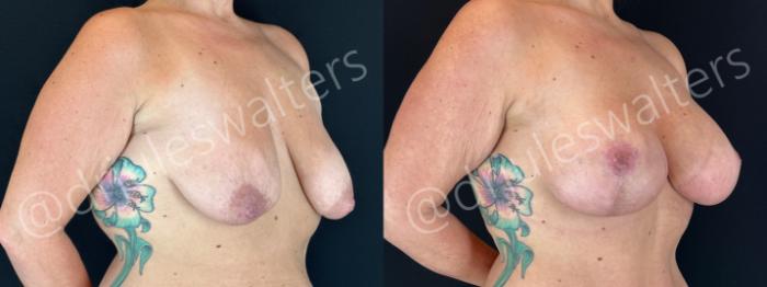 Before & After Breast Augmentation + Lift Case 191 Right Oblique View in Metairie and New Orleans, LA