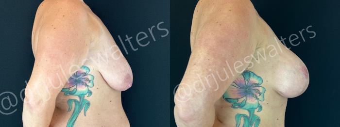 Before & After Breast Augmentation + Lift Case 191 Right Side View in Metairie and New Orleans, LA