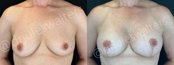 Before & After Breast Augmentation + Lift Case 200 Front View in Metairie and New Orleans, LA