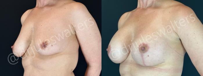 Before & After Breast Augmentation + Lift Case 200 Left Oblique View in Metairie and New Orleans, LA