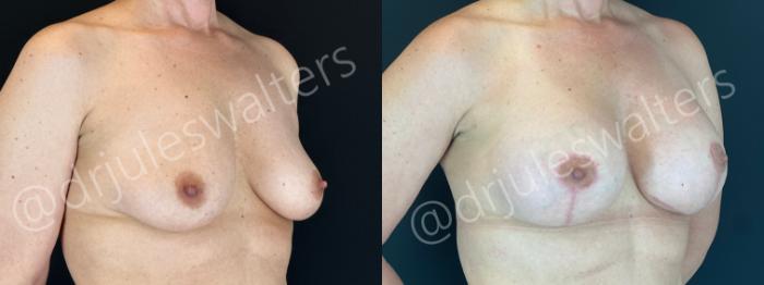 Before & After Breast Augmentation + Lift Case 200 Right Oblique View in Metairie and New Orleans, LA