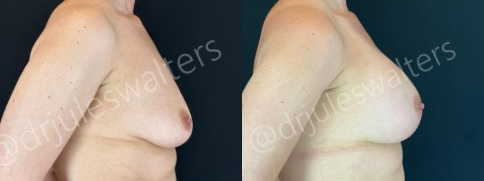 Before & After Breast Augmentation + Lift Case 200 Right Side View in Metairie and New Orleans, LA