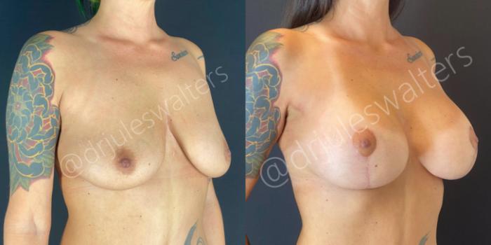 Before & After Breast Augmentation + Lift Case 62 View #2 View in Metairie and New Orleans, LA