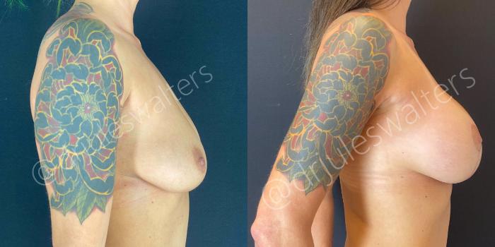 Before & After Breast Augmentation + Lift Case 62 View #3 View in Metairie and New Orleans, LA