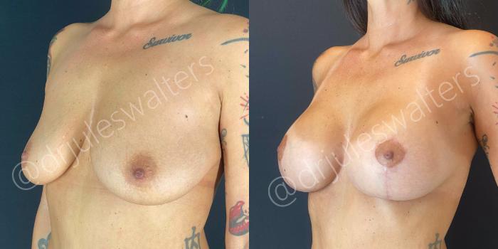 Before & After Breast Lift Case 62 View #4 View in Metairie and New Orleans, LA