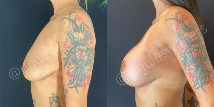 Before & After Breast Augmentation + Lift Case 62 View #5 View in Metairie and New Orleans, LA